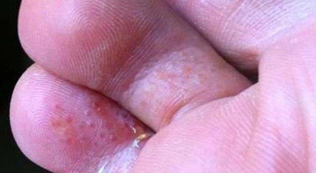 水泡和糜烂型脚气是什么惹起的