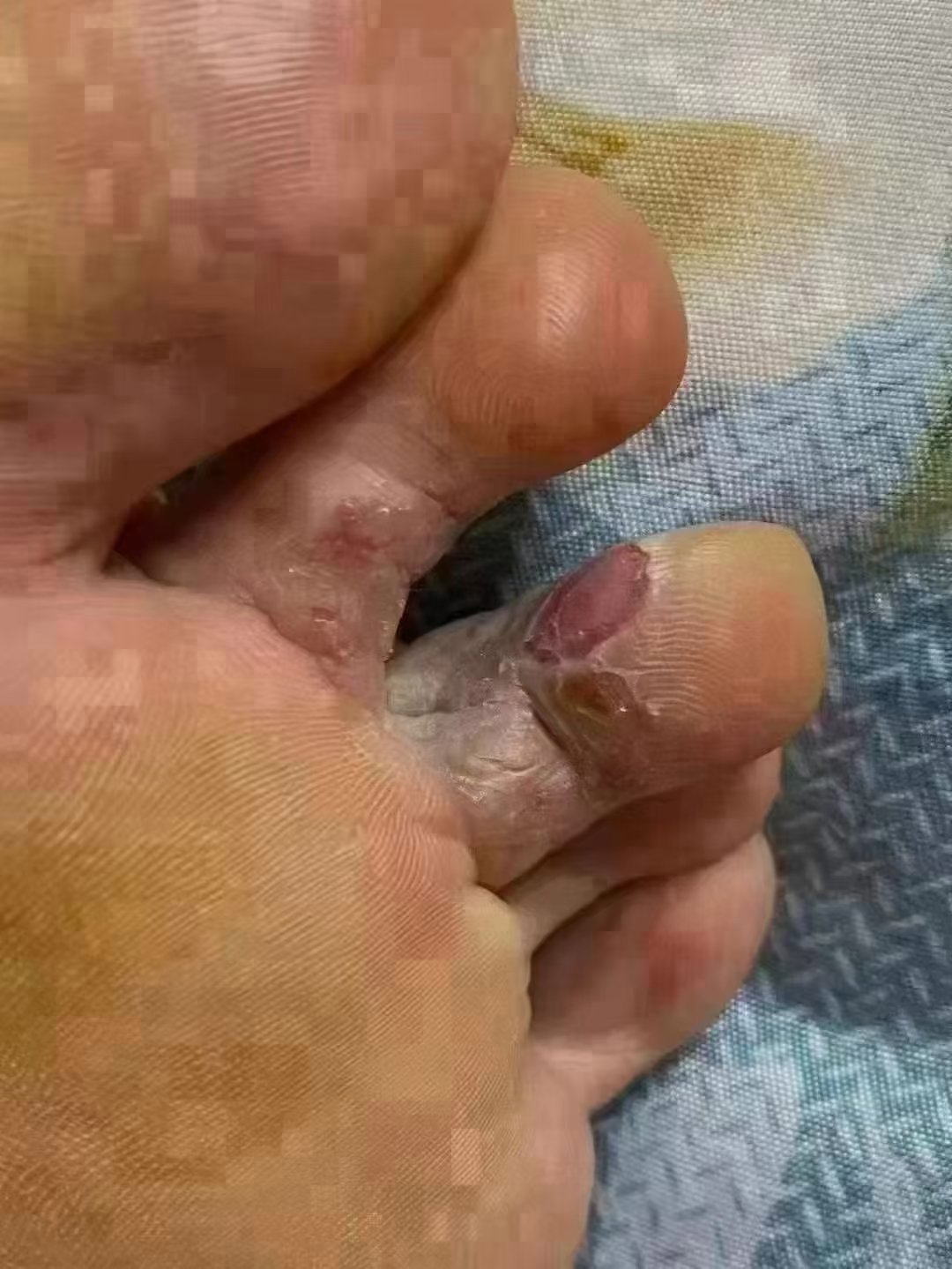 怎样有用减缓糜烂型脚气的瘙痒病症(图1) 怎样有用减缓糜烂型脚气的瘙痒病症