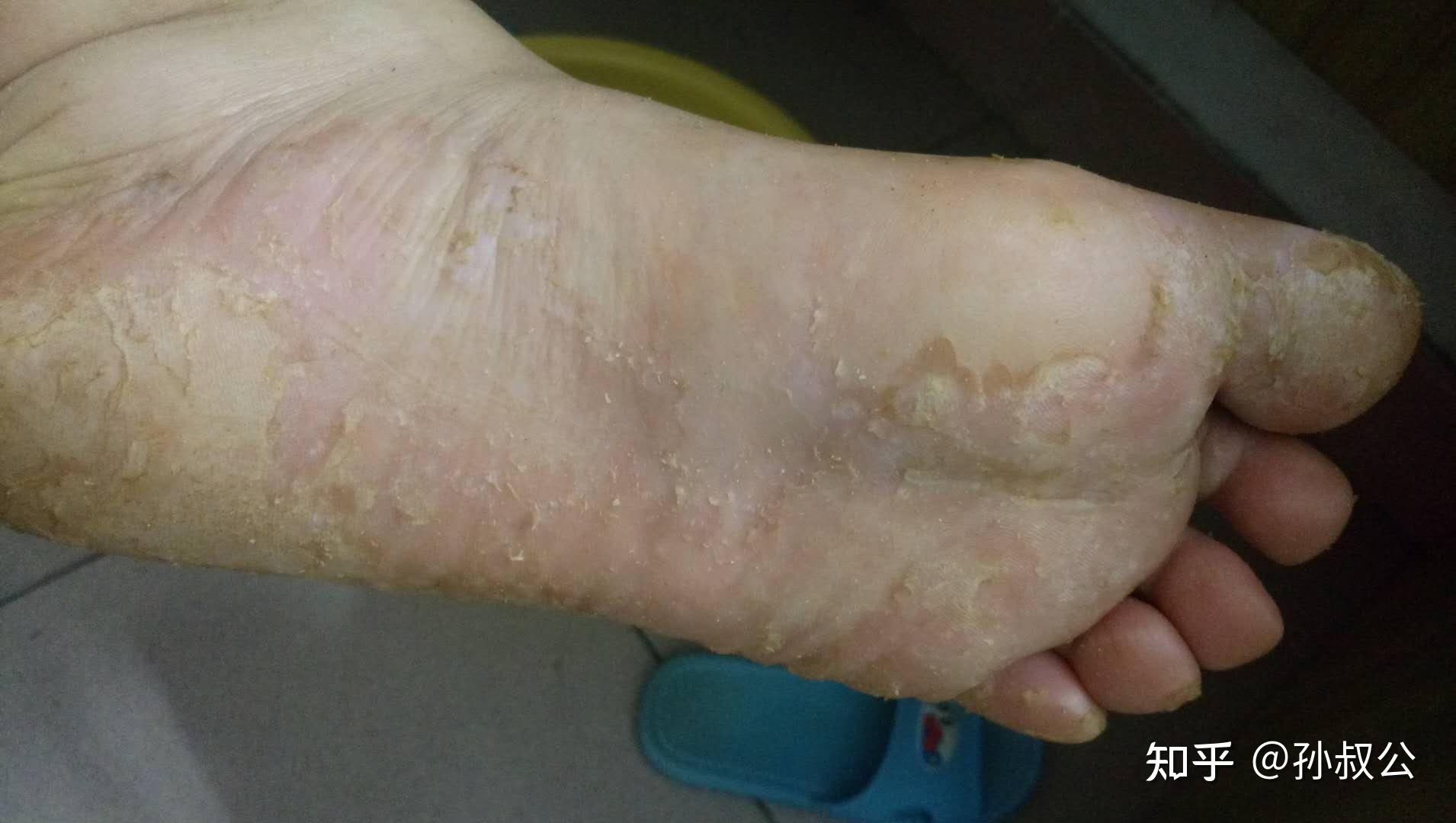 医治水泡型脚气的药有哪些