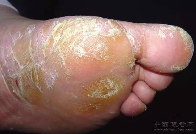 女性患脚气多年脚指痒受热减轻怎样办(图1) 女性患脚气多年脚指痒受热减轻怎样办