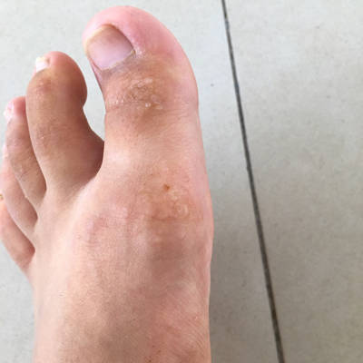 脚气严峻痒的难熬痛苦怎样办