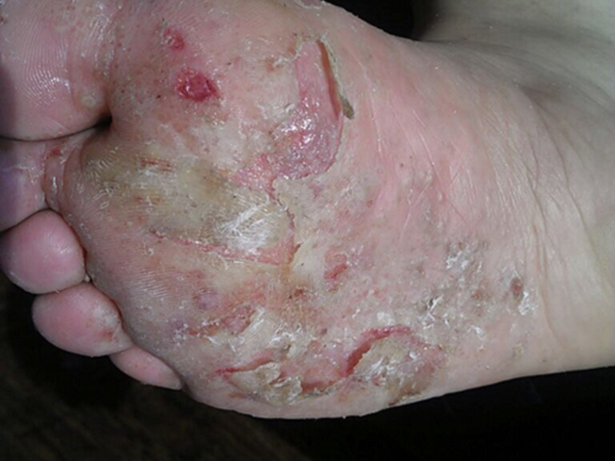 脚气惹起的腐败流脓