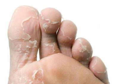 夏季警觉脚气感染百口安康需配合保护