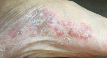 有脚气水疱痒擦什么药膏