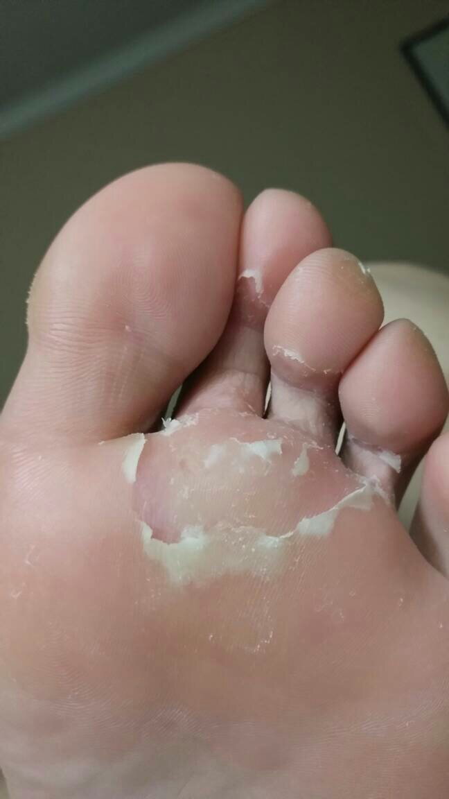 角化型脚气怎样医治