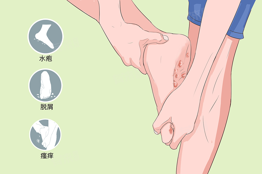 水泡脚气的病症