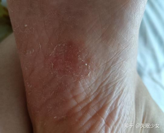 脚脱皮不痒不臭只脱皮怎样治