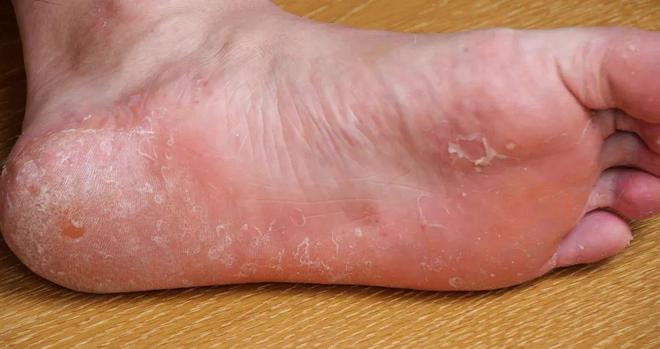 这3种夏日多发皮肤病许多人痒到受不了！快自查→（附止痒攻略）(图3)