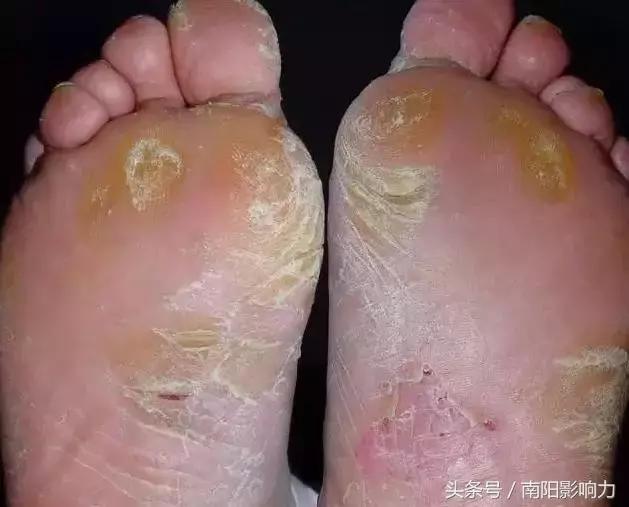 脚气脱皮怎样根治