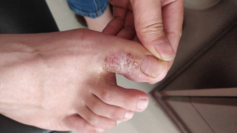 脚上脱皮是脚气吗