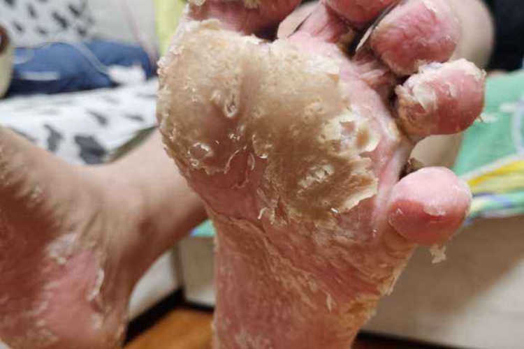 脚气掉下的干皮屑感染吗