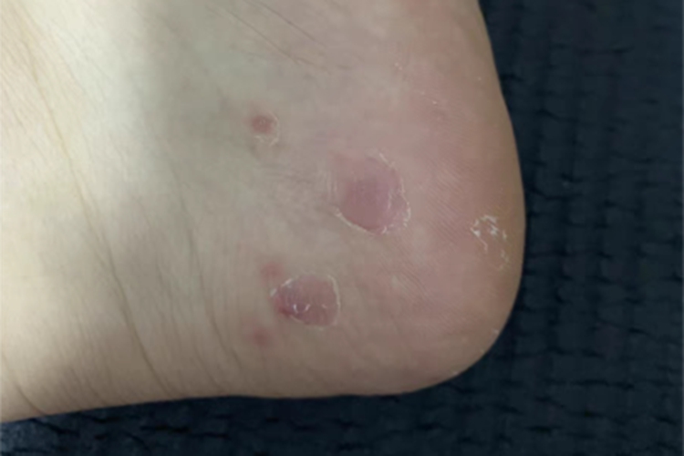 脚气长白色的黑点很痒怎样回事