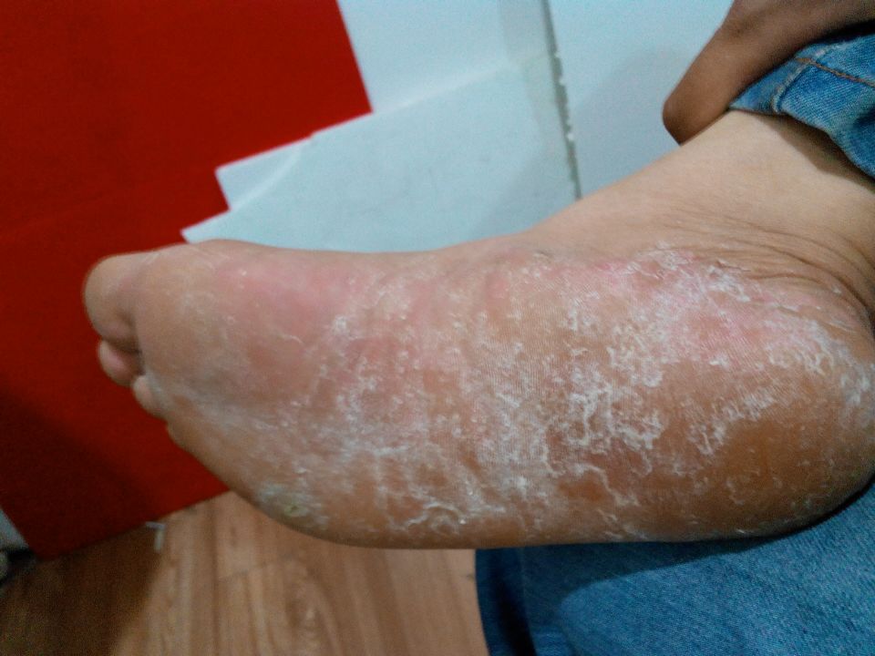 糜烂型脚气能够自愈吗