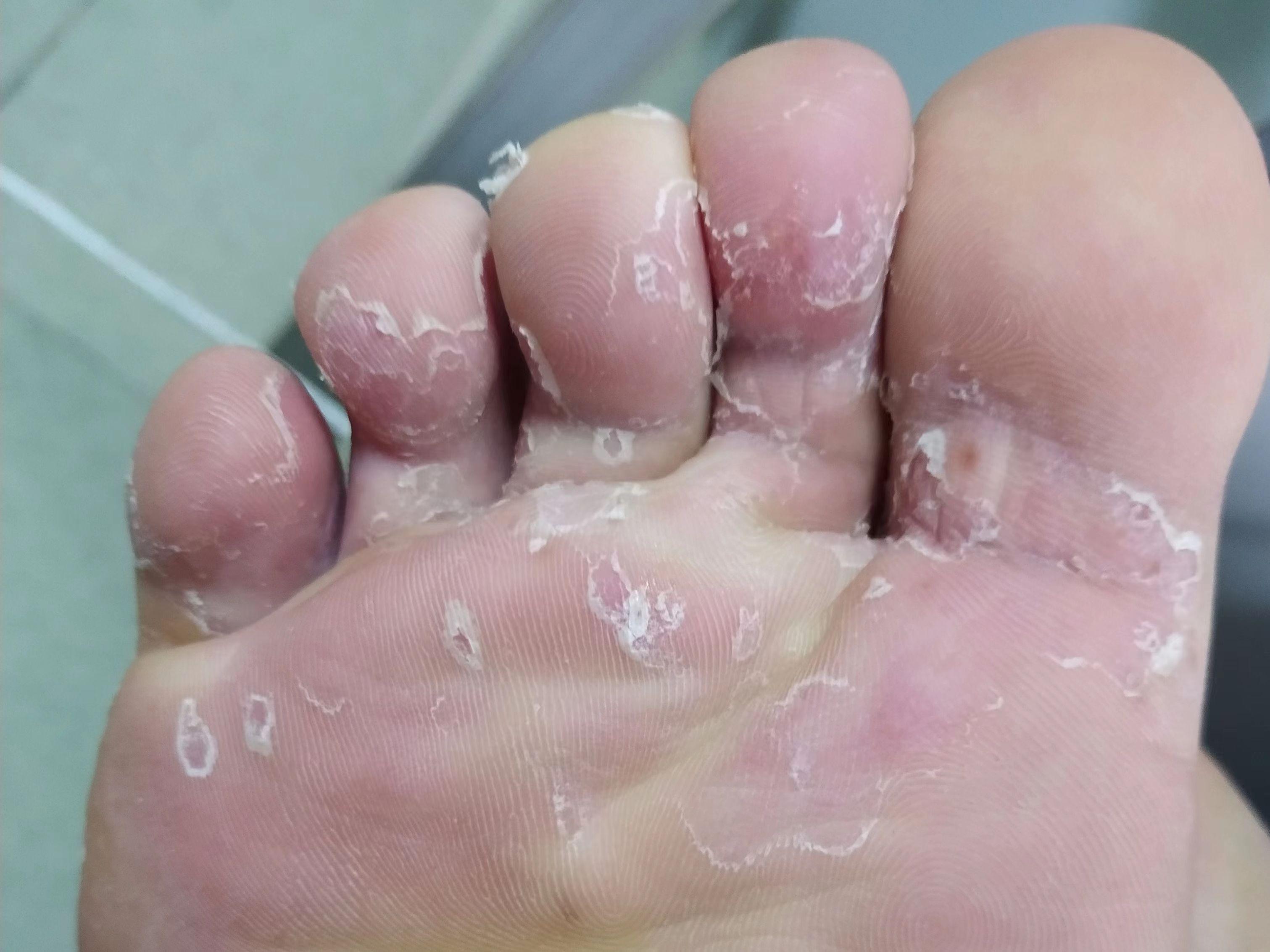 有什么治角化鳞屑型脚气的好药能引见