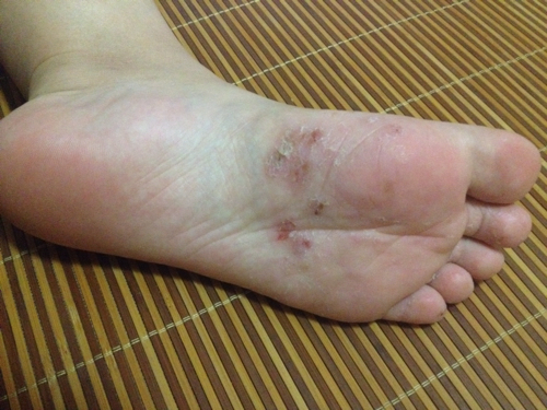 脚上有红点