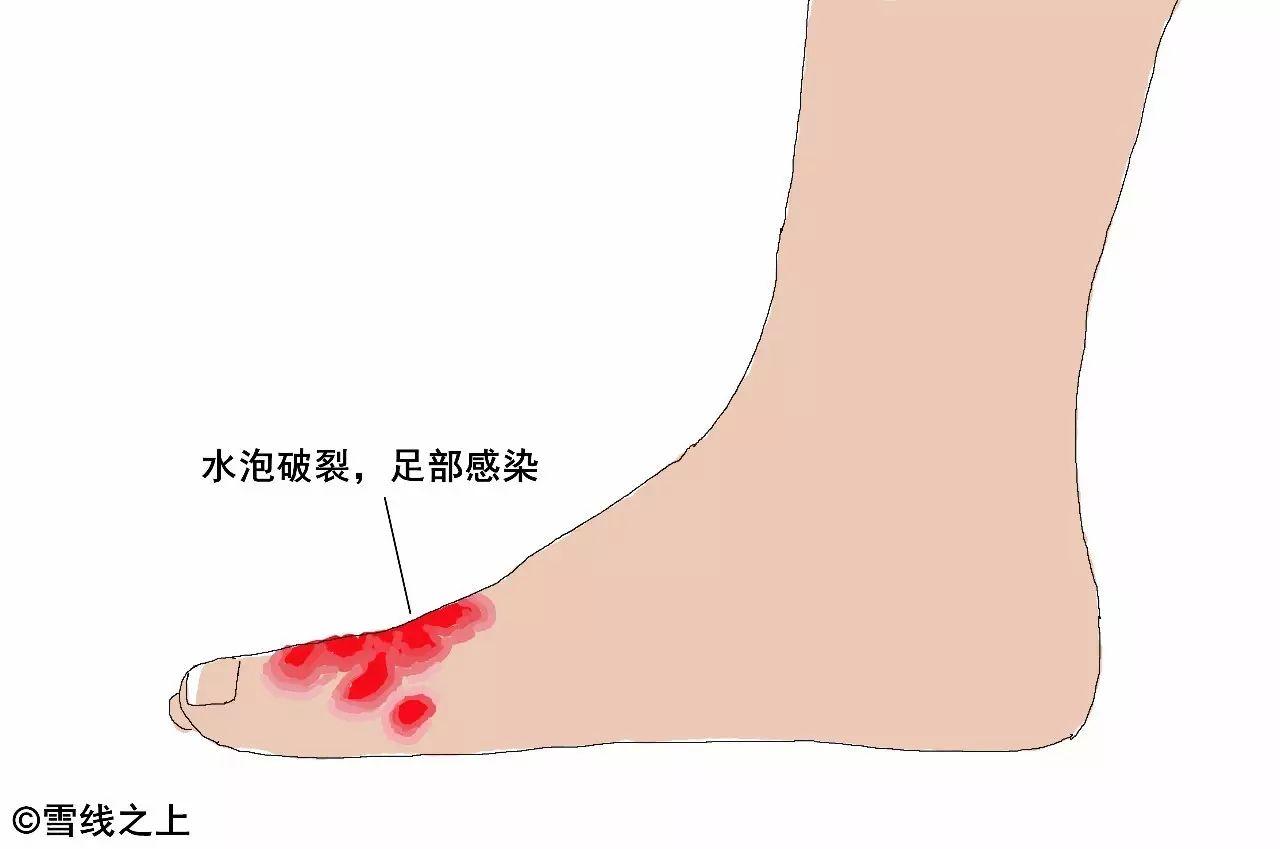 脚部水泡雨水浸泡诱发(图1) 脚部水泡雨水浸泡诱发