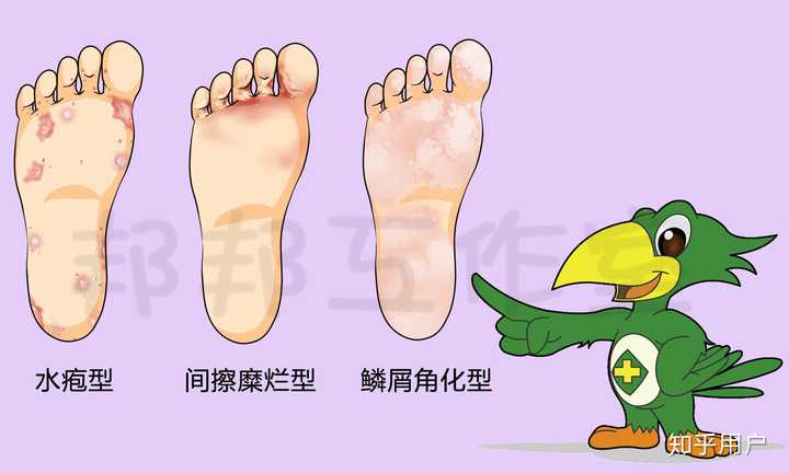脚气的病因和发病机制