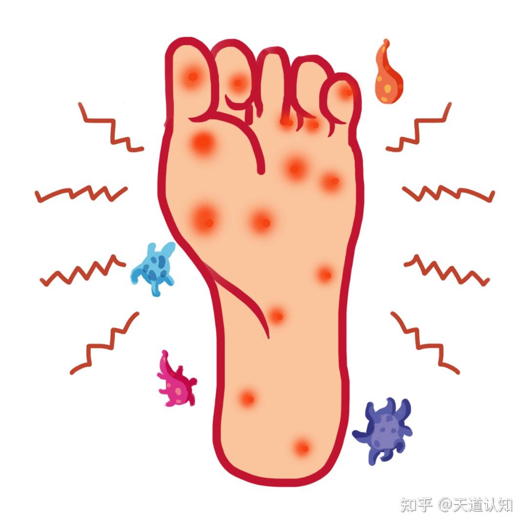 红斑脚气足部清洁频次