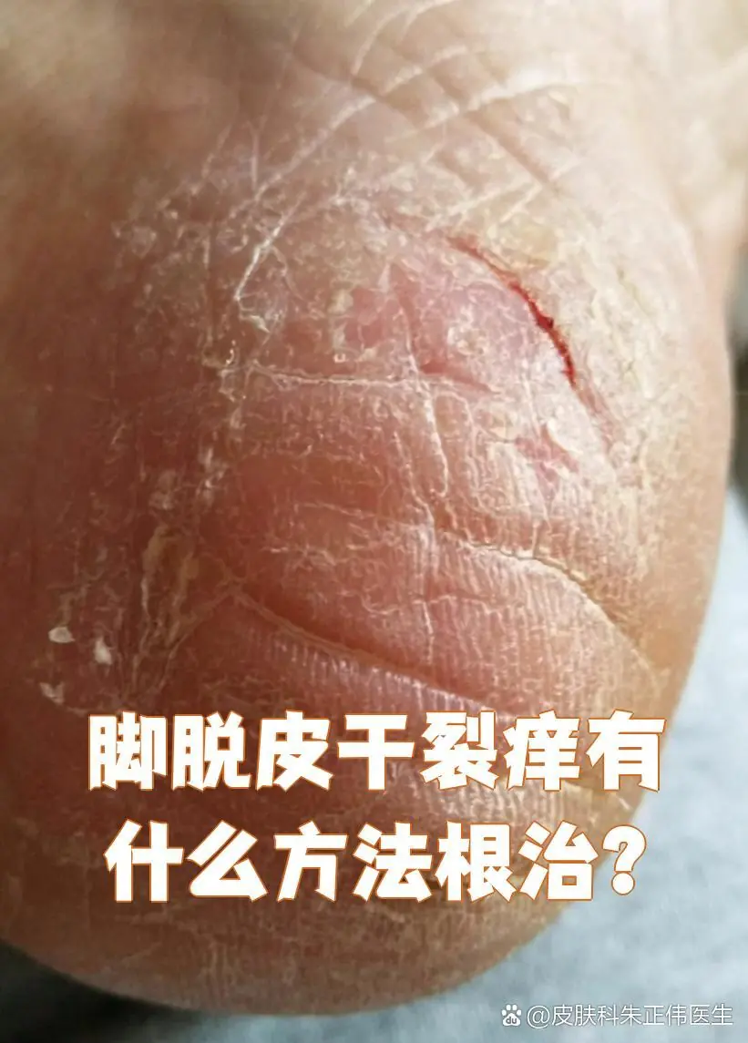 低温干燥脚部干裂脱皮
