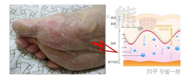 红斑脚气老旧角质软化