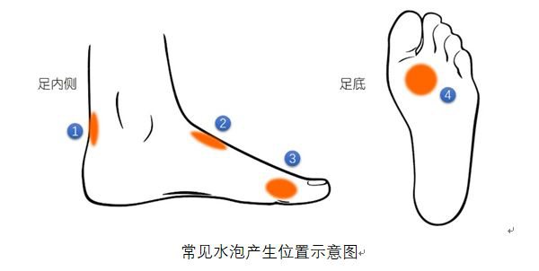 脚部水泡鞋带过紧压迫(图1) 脚部水泡鞋带过紧压迫