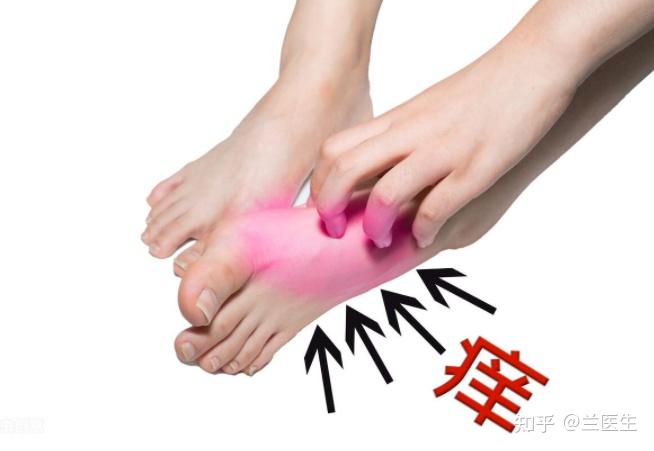 脚部水泡密闭鞋腔滋生(图1) 脚部水泡密闭鞋腔滋生
