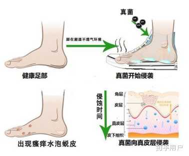 脚部水泡循环障碍诱因(图1) 脚部水泡循环障碍诱因