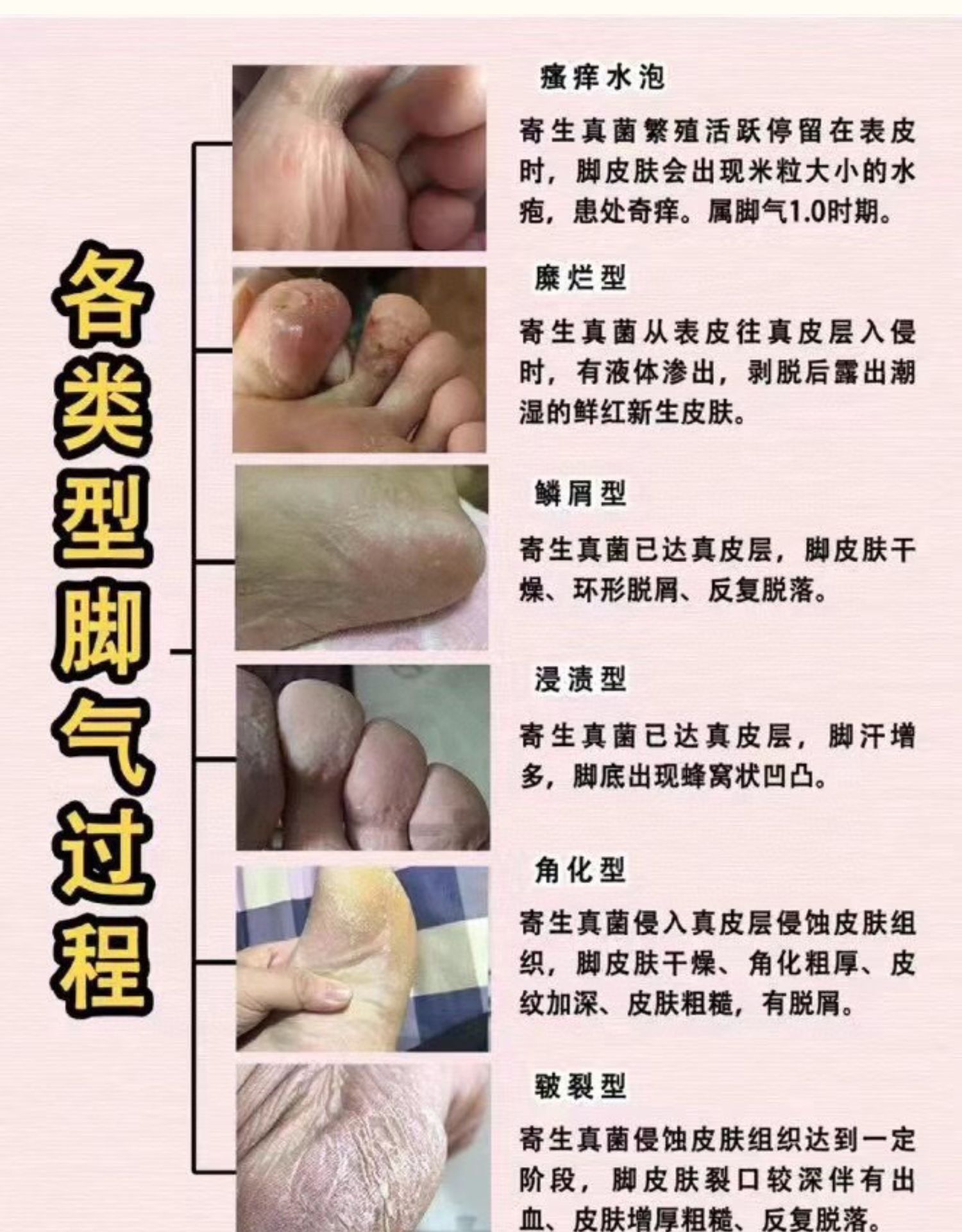 红斑脚气燥热舒缓降温