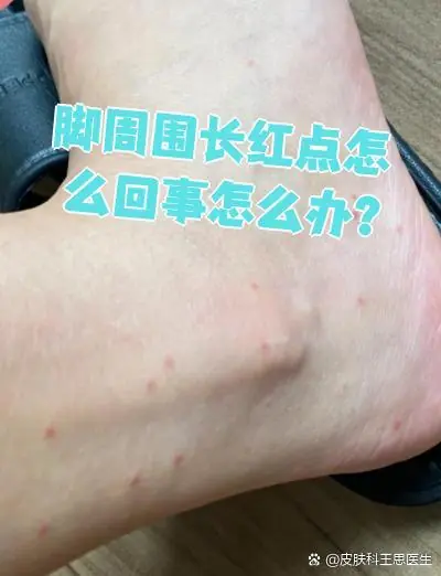脚部红斑点状泛红改善(图1) 脚部红斑点状泛红改善
