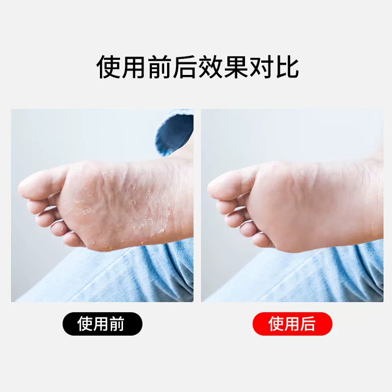 脚底厚重角质脱皮去除(图1) 脚底厚重角质脱皮去除