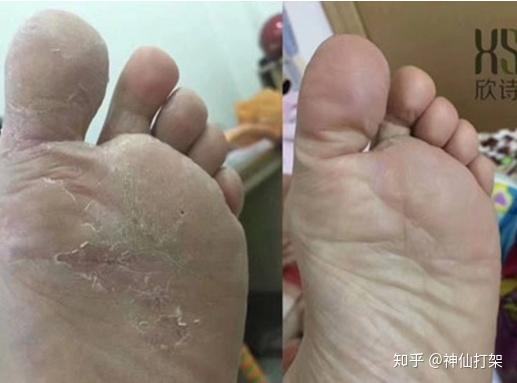 脚部脱皮是脚气吗(图1) 脚部脱皮是脚气吗