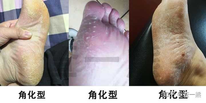脚部水泡条件性感染成因