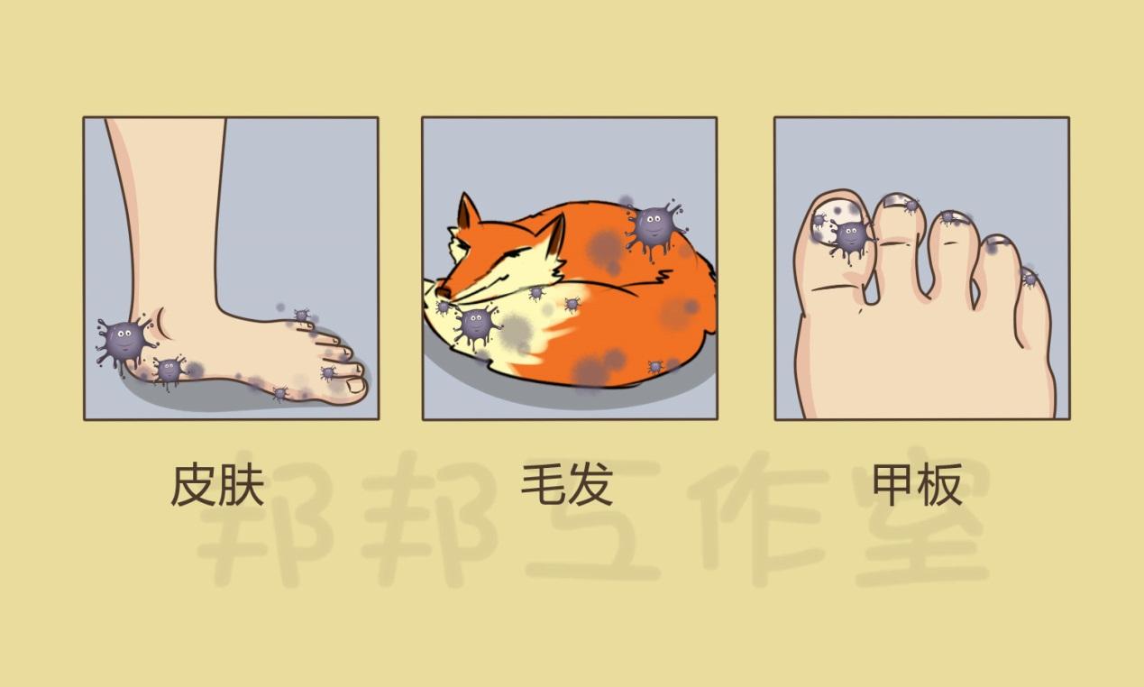 脚部浅表真菌清除