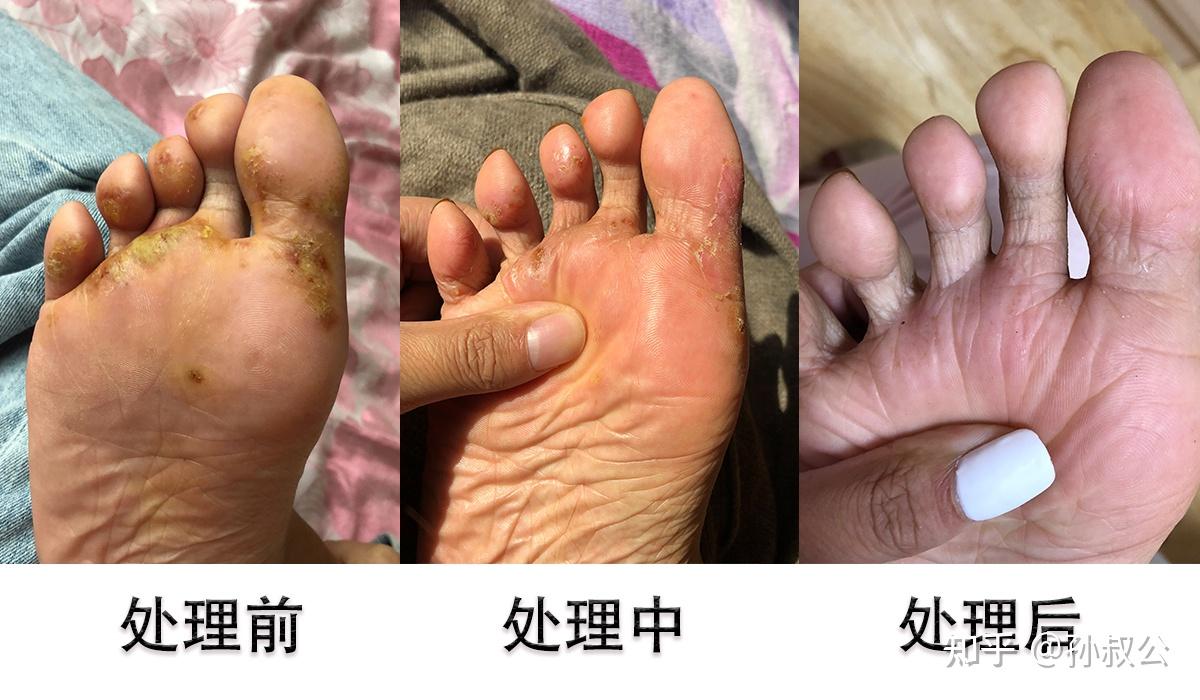 真菌脚臭彻底根治(图1) 真菌脚臭彻底根治