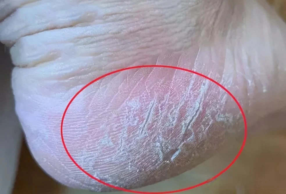 脚部脱皮角质翘起处理