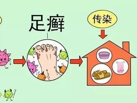 【医生提醒】足癣防治的注意事项(图1) 【医生提醒】足癣防治的注意事项