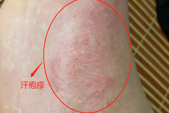 脚部水泡多汗体质高发(图1) 脚部水泡多汗体质高发