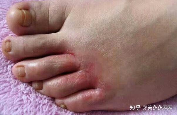 水泡型脚气预防常识(图1) 水泡型脚气预防常识