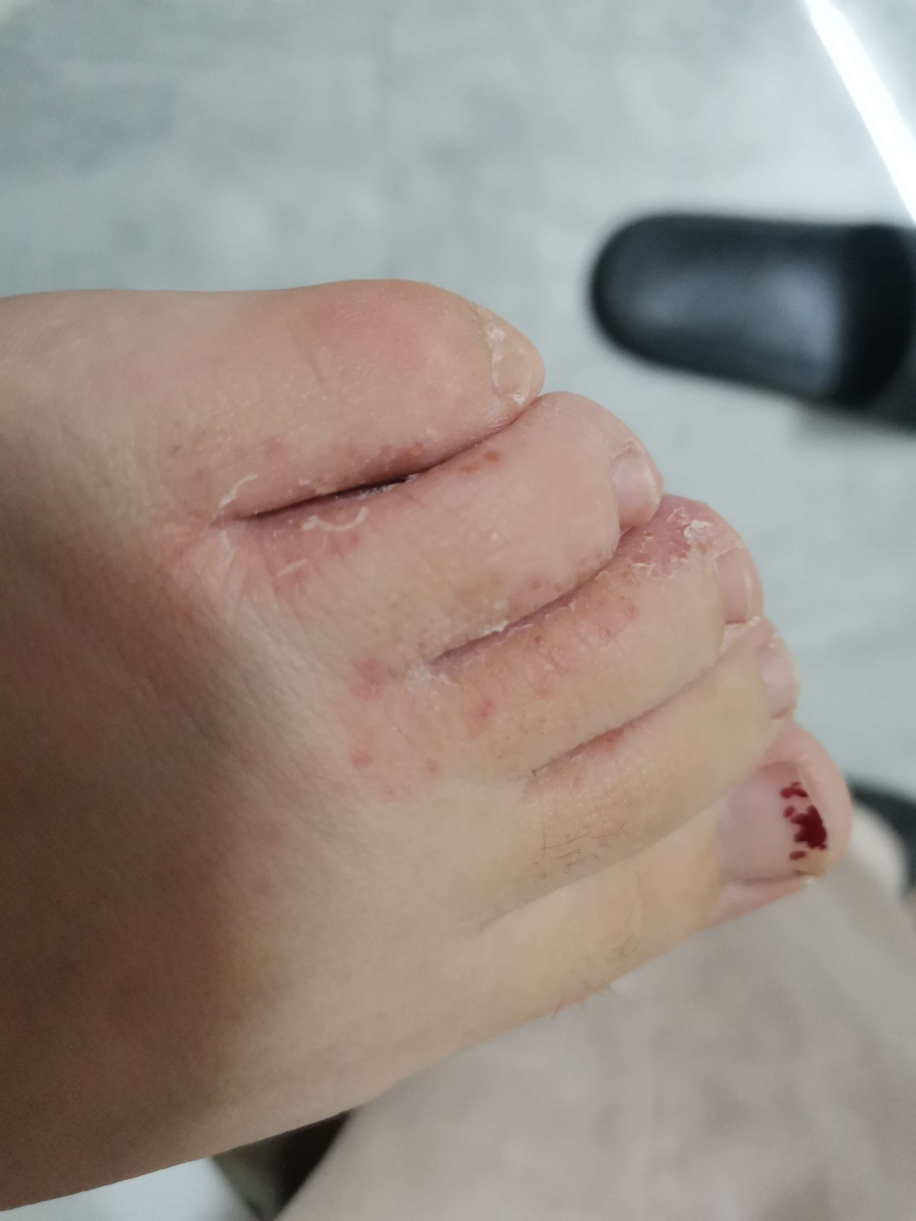 脚趾缝隙长期潮湿痒(图1) 脚趾缝隙长期潮湿痒