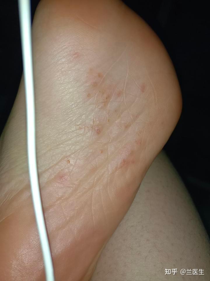 脚部边缘脱屑修护