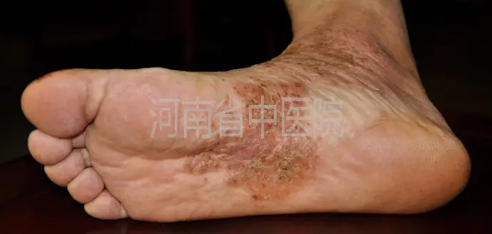 脚部红斑洗涤剂刺激成因