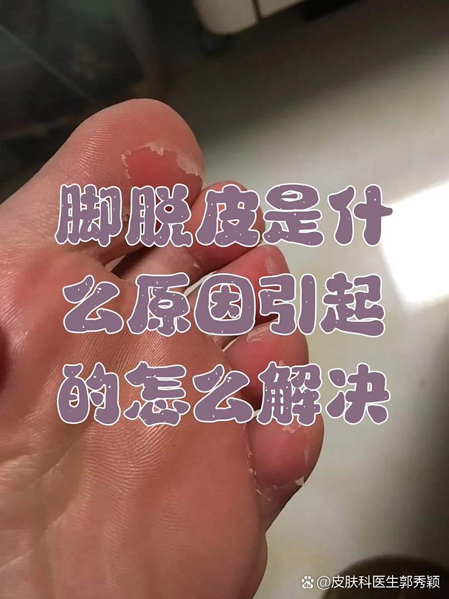 脚部脱皮容易破损(图1) 脚部脱皮容易破损