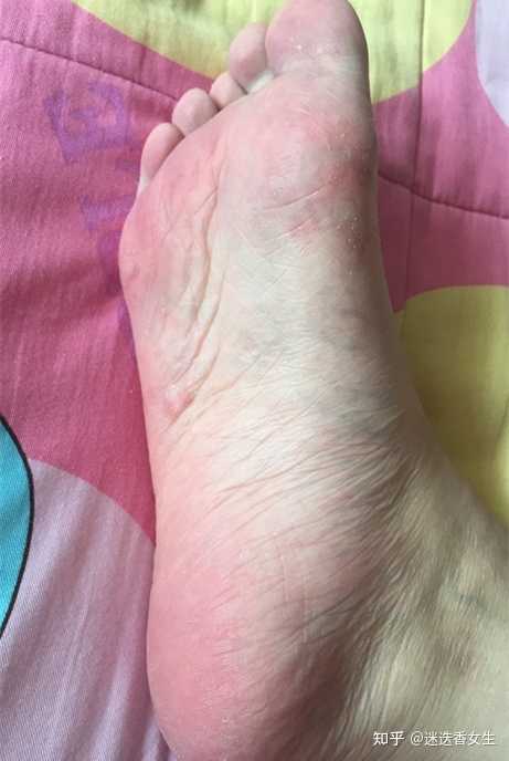 水泡型脚气脚垫定期清洗(图1) 水泡型脚气脚垫定期清洗