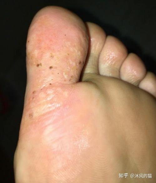 水泡型脚气胶鞋穿戴防护(图1) 水泡型脚气胶鞋穿戴防护