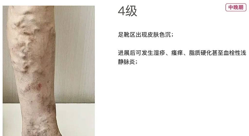 脚部红斑久站静脉回流差成因(图1) 脚部红斑久站静脉回流差成因