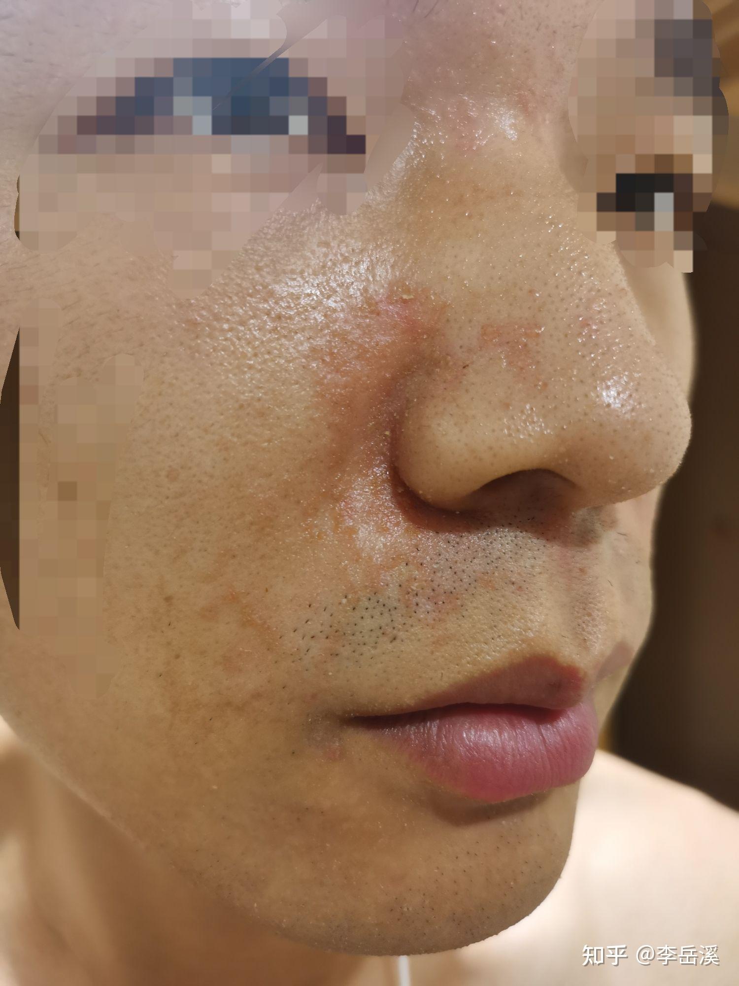 脚部红斑脂溢性皮炎诱发(图1) 脚部红斑脂溢性皮炎诱发