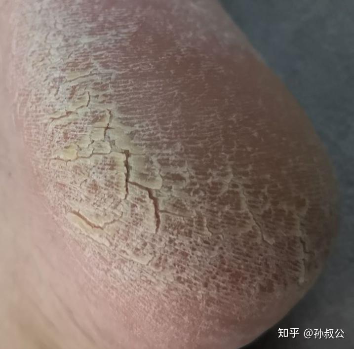 脚部糜烂温和快速调理