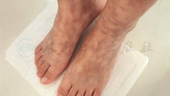 脚部红斑气血不足诱发