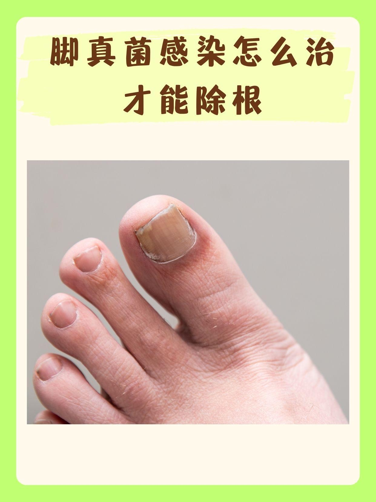 【专家解读】脚部真菌感染的最新治疗方法(图1) 【专家解读】脚部真菌感染的最新治疗方法