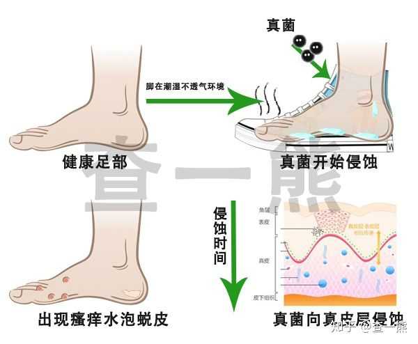 红斑型脚气传播途径(图1) 红斑型脚气传播途径